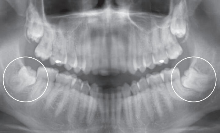 Radiographie des dents de sagesse Radiographie panoramique montrant les dents de sagesse incluses